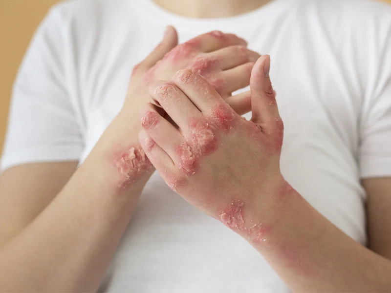 Psoriasis800